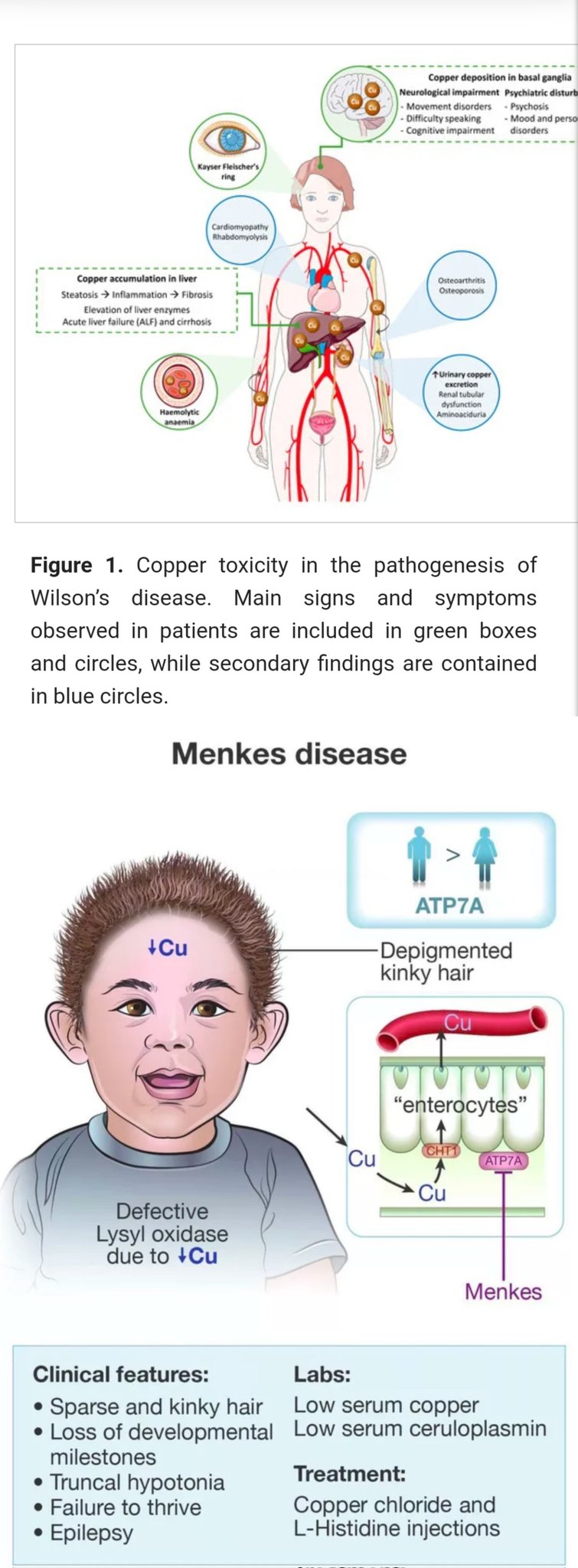 Menkes kinky hair disease A case report  Cases Journal  Full Text