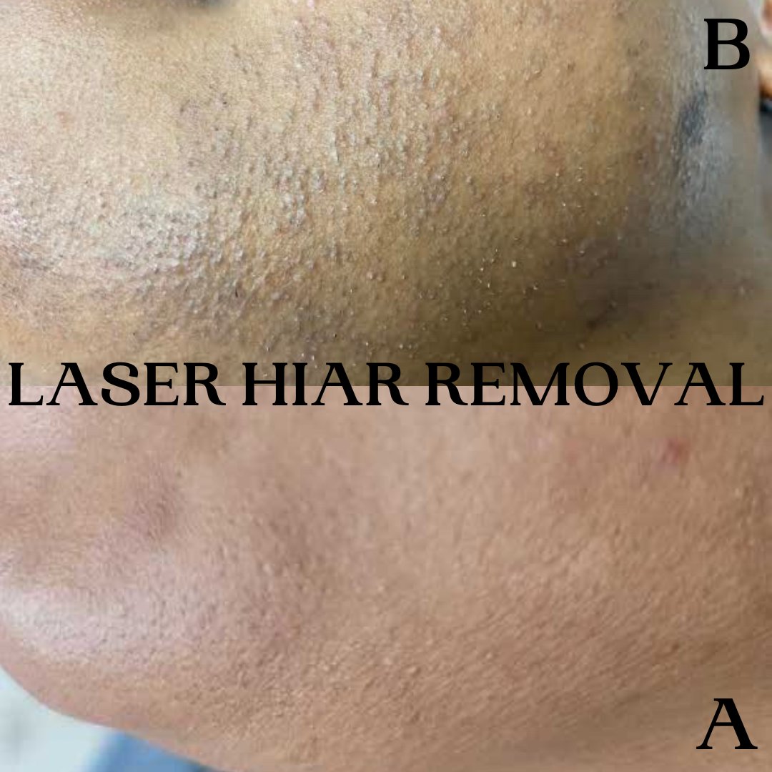 SkinsationsATL's tweet photo. ✨Transformation Tuesday!✨
We can't say enough great things about Laser Hair Removal! See the awesome improvement in this client's Chin area.
This week's Flash Sale is Hair-Free Faces! 8 Medium Sessions for $325 (Face Only!) 9/1 - 9/10
#FYP #TrendingNow #viral #Skin https://t.co/Q6ckRJzWGn