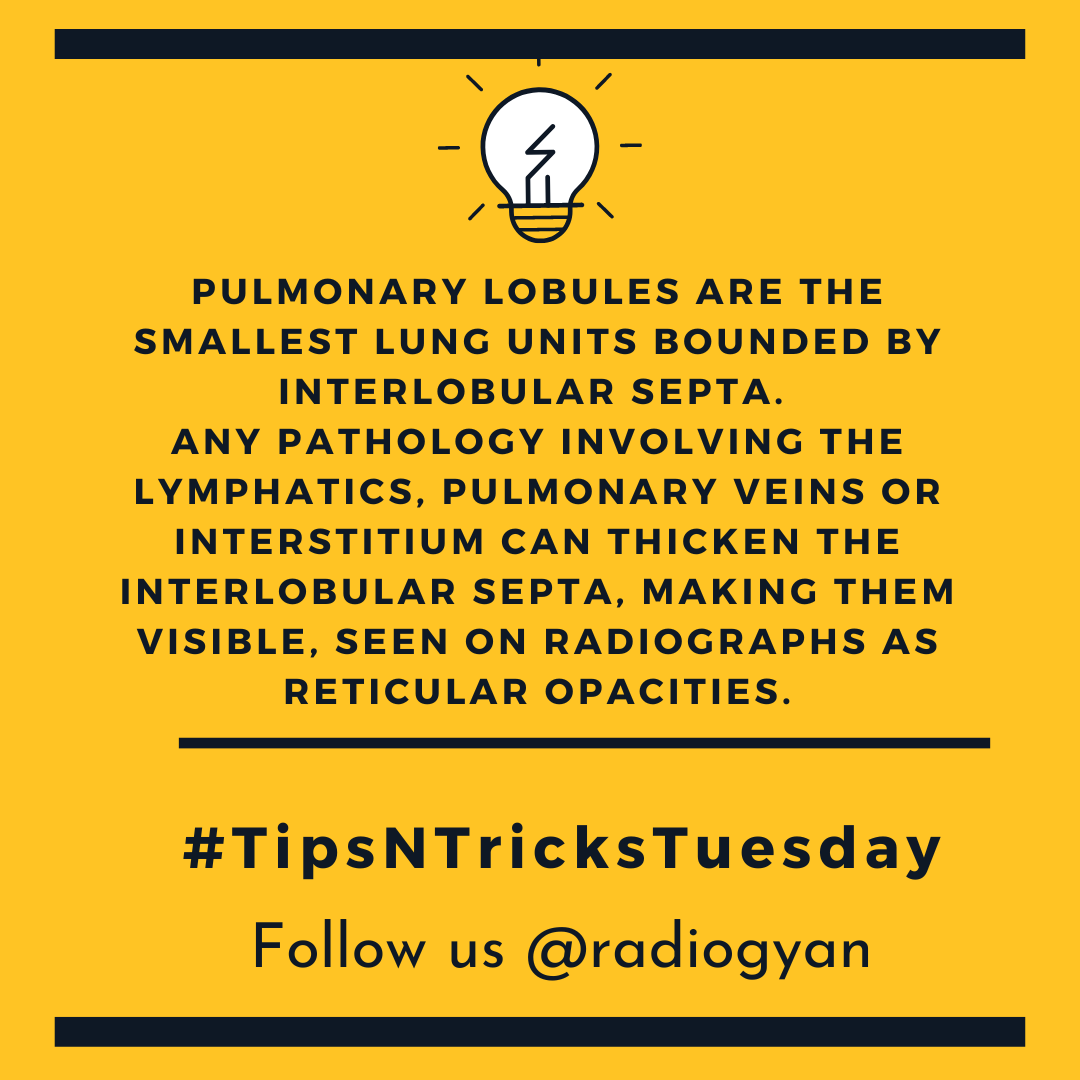 TeamRadioGyan's tweet image. #TipsnTricksTuesday 

Here is a new pearl about pulmonary lobules. 

All credits to #TeamGyan member Dr. Disha Lokhandwala.
Follow her on Instagram @dishasradiologyillustrations.

#hrct #lungs #thoracic
#Foam #radres #radiogyan    
#radiology #education #internet