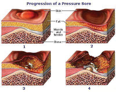 PeteReed's tweet image. Day 6/30

Skincare.

If you have a strong stomach, search: “SCI Pressure Ulcers”.

This is SCI Enemy #1 and my biggest fear.

With reduced blood circulation, flesh behaves like an old plum under even mild pressure. It’s a killer.

#SCIawarenessmonth
#6Sep2022
#CheckCheckCheck