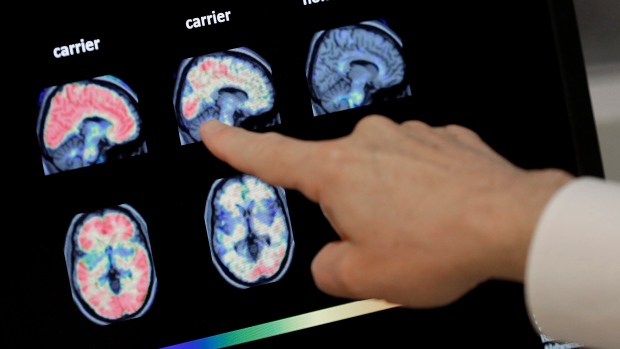 CTVNews's tweet photo. Cathy Barrick, CEO of the Alzheimer Society of Ontario, warns that dementia cases are expected to skyrocket and urgent action is needed now. https://t.co/LzAyzbO9sU https://t.co/d4TqohF1LS