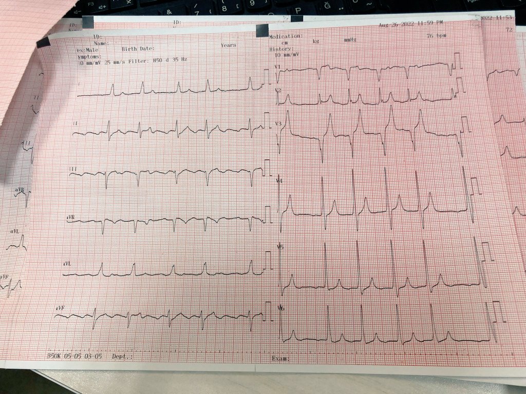 Before and after calcium gluconate iv - (51y,male, Potassium 8.6 mmol/L) #CardioTwitter #CardioEd #FOAMed
#ECG