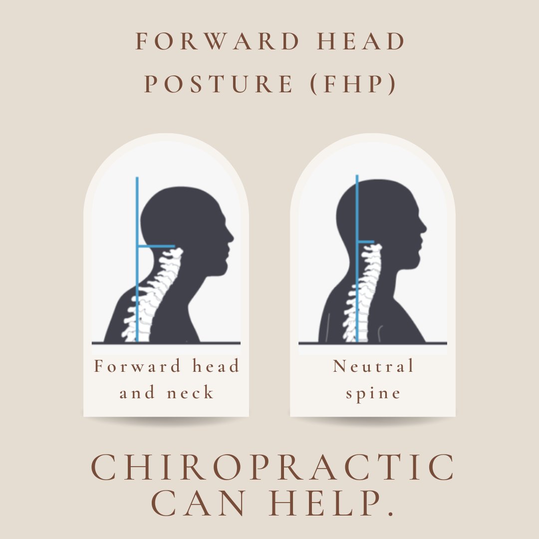 drmichaellau's tweet photo. Are you experiencing headaches, neck/upper back discomfort, muscle tension, mid back pain, or numbness in the arms and/or hands? These may be signs of forward head posture (FHP). Regular Chiropractic care can help with that. 🙌🏼
#Chiropractic #ChiroCare #ForwardHead https://t.co/84vtWadnFr