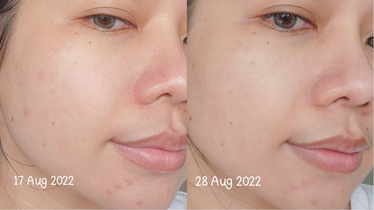 ChaliReviews's tweet photo. ขอป้ายยาโฟมล้างหน้าลดสิว Eucerin Pro Acne Soft Cleansing Foam ที่หนึ่งในดวงใจบอกเลย ทั้งสิวอุดตัน รอยสิว คือลดลง สิวไม่ค่อยกลับมาขึ้นซ้ำอีก ฟองโฟมนุ่ม ล้างสะอาด หน้าไม่แห้งตึง ใช้แล้วรู้สึกหน้ามันน้อยลงด้วย ใครเป็นสิวอยู่ควรไปตำ #ใช้ดีบอกต่อ #eucerinthailand https://t.co/lciD4OKbsU