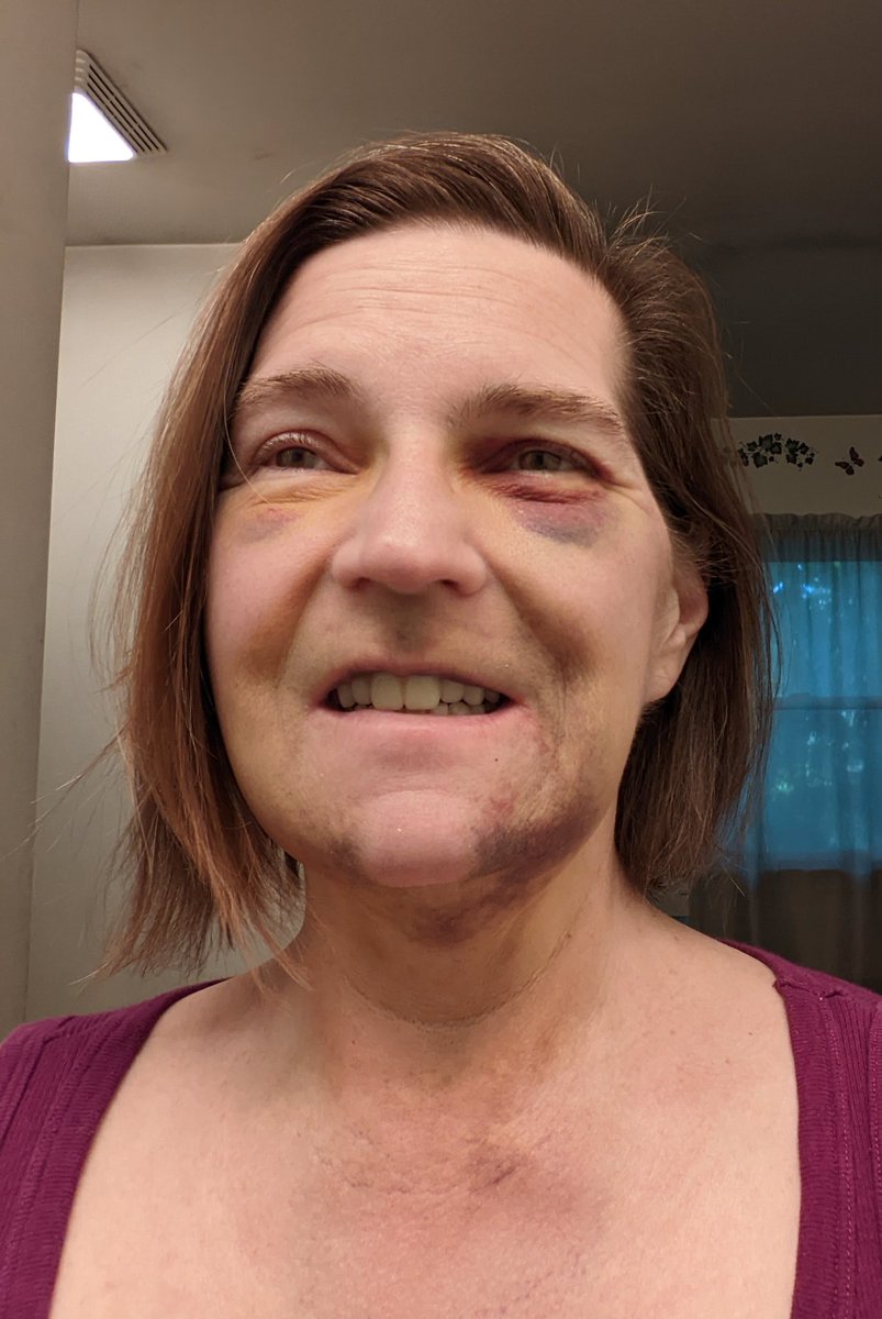 MsBevEducator's tweet photo. Healing continues, bruises like a 5 o'clock shadow, hurts to laugh. Smile through the pain. #bevolution #oralsurgery #clearchoice https://t.co/u3HpwFHHeg