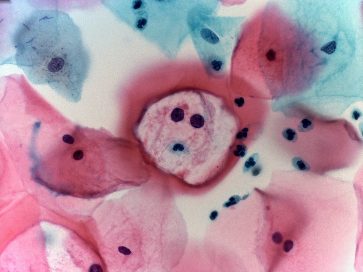 Sad koilocyte.. just found out he is a-  16 high risk😞
