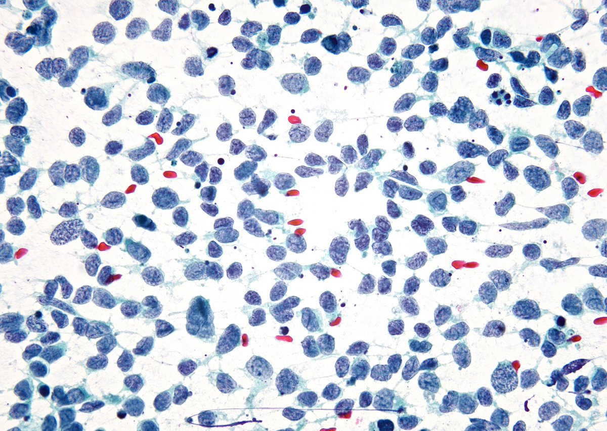 "Oats with Salt and Pepper" - Small Cell Carcinoma, Lung. (FNA)