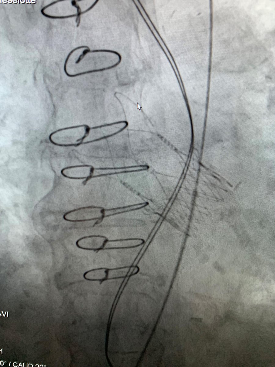 BSCCardiology's tweet photo. Congrats to Dr. @RodrigoBagur and Dr. @MichaelMwachu and the #TAVR team at @LHSCCanada for completing the first commercial ACURATE neo2™ Implants in Canada! All three cases achieved successful commissural alignment with no conduction disturbances. #DESIGNEDFORALIFETIME https://t.co/0dDAKI9yYq