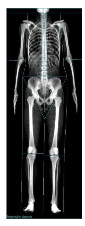 Our paper on the precision of the @GEHealthcare iDXA for measurement of total body less head body composition is now available online. Quick turnaround and efficient process from the Journal of Clinical Densitometry <a href="/Densitometry/">ISCD</a> sciencedirect.com/science/articl…