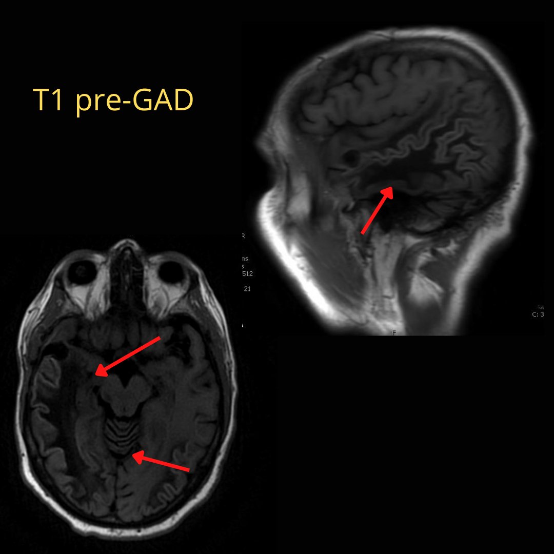 NeuroimagingN's tweet photo. Hyperintense cortical signal on T1 pre-GAD
·
In the setting of Progressive multifocal leukoencephalopathy (PML)

#PML #immunodeficiency #neuroinfectiousdiseases #neuroinflammation #neuroimmunology #neurology #neuroradiology #radiology #neurosciences #neurotwitter https://t.co/bPktd47bqX