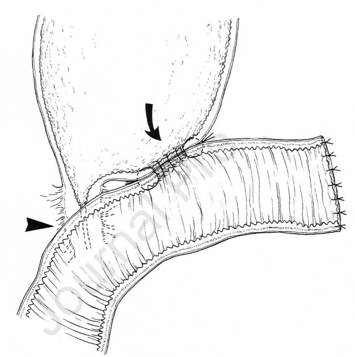AmJSurgery (@amjsurgery) on Twitter photo Revision skip Hepaticojejunostomy for refractory benign strictures uncontrolled by non-surgical endoscopic and transhepatic interventional approaches: A novel surgical approach 🔋💥🪖! #SoMe4Surgery <a href="/herbchen/">herb chen</a> <a href="/pferrada1/">Paula Ferrada MD FACS FCCM MAMSE</a> <a href="/PipeCabreraV/">Dr Luis Felipe Cabrera Vargas MD FACS MACC MACCVA</a> @cirbosque <a href="/SWexner/">Steven D Wexner MD, PhD</a> <a href="/juliomayol/">Julio Mayol</a> <a href="/MISIRG1/">MISIRG</a> Revision skip Hepaticojejunostomy for refractory benign strictures uncontrolled by non-surgical endoscopic and transhepatic interventional approaches: A novel surgical approach 🔋💥🪖! #SoMe4Surgery <a href="/herbchen/">herb chen</a> <a href="/pferrada1/">Paula Ferrada MD FACS FCCM MAMSE</a> <a href="/PipeCabreraV/">Dr Luis Felipe Cabrera Vargas MD FACS MACC MACCVA</a> @cirbosque <a href="/SWexner/">Steven D Wexner MD, PhD</a> <a href="/juliomayol/">Julio Mayol</a> <a href="/MISIRG1/">MISIRG</a>