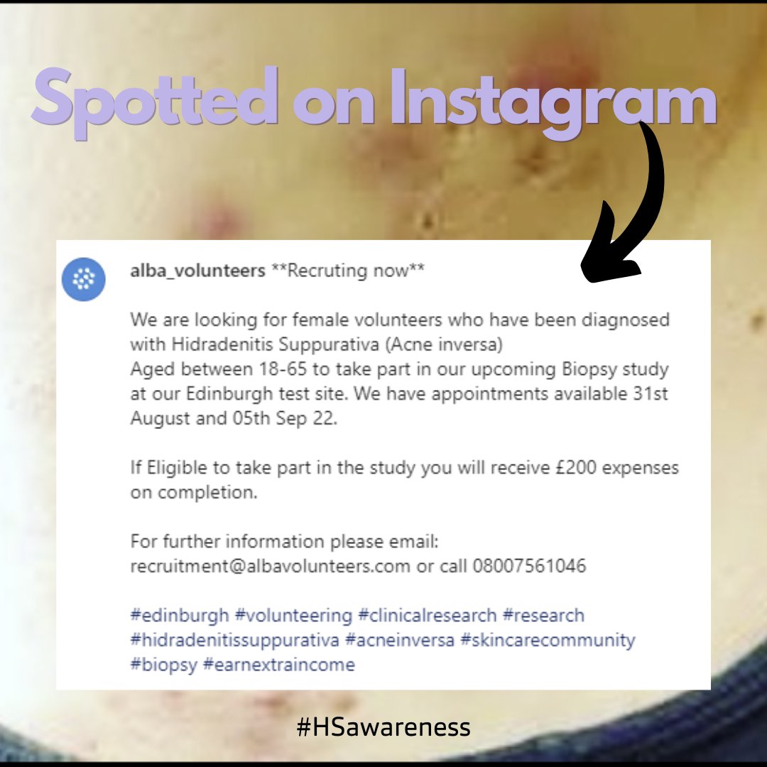 TGHSAC's tweet photo. Sharing from @alba_voluteers on Instagram - visit their insta for details
#HidradenitisSuppurativa #HS #skin
#hidradenitissuppurativa #HS #HSresearch https://t.co/yCofCCAnKr