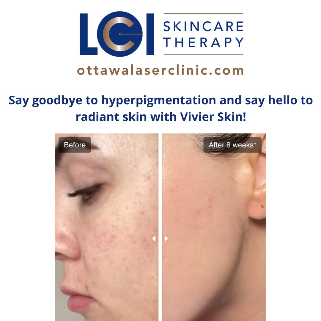 Are you experiencing hyperpigmentation after a summer in the sun? LCI recommends turning to Vivier Skin. Vivier Skin has a number of products, perfect for reducing dark spots.

If you want to learn more about hyperpigmentation, click here -
vivierskin.ca/blogs/vivier-l…