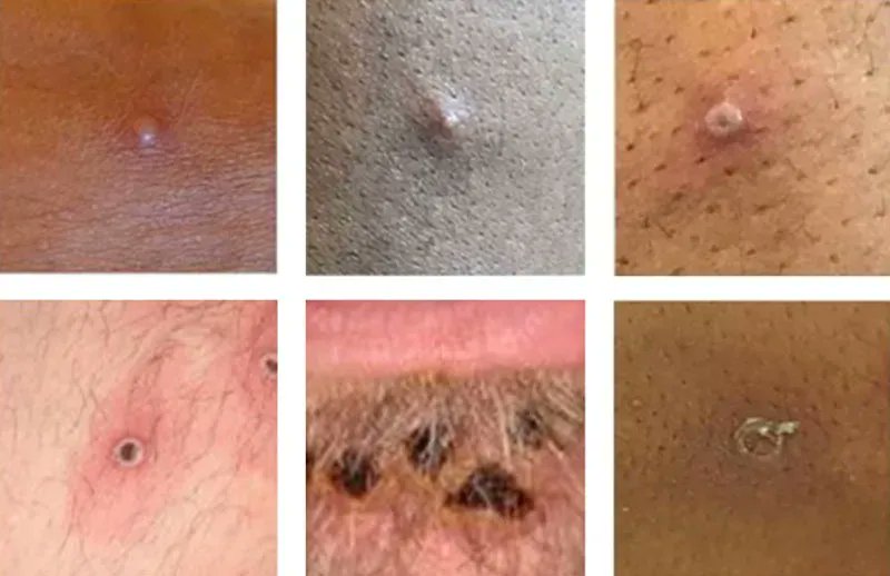 ez2stop's tweet photo. How would you know if you have #monkeypox? Your #healthcareprovider would order testing. If you have a rash that looks like monkeypox, follow up with your doctor: https://t.co/FXicYvwTC5 https://t.co/aNCrBCOTZf