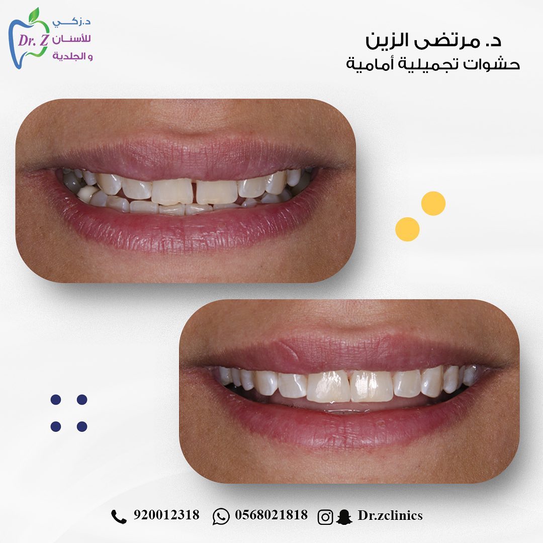 mortada517's tweet photo. إغلاق فلجة بين الأسنان الأمامية بالحشوات التجميلية ✨️ https://t.co/WmCVAZL5c7