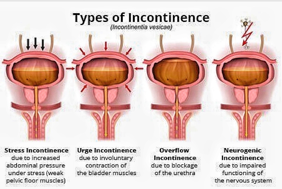 BrownJHM's tweet photo. Types of incontinence (unknown source) #BJHM #MedEd #Medtwitter #Urology #incontinence #medstudenttwitter https://t.co/5x6tLatgn0