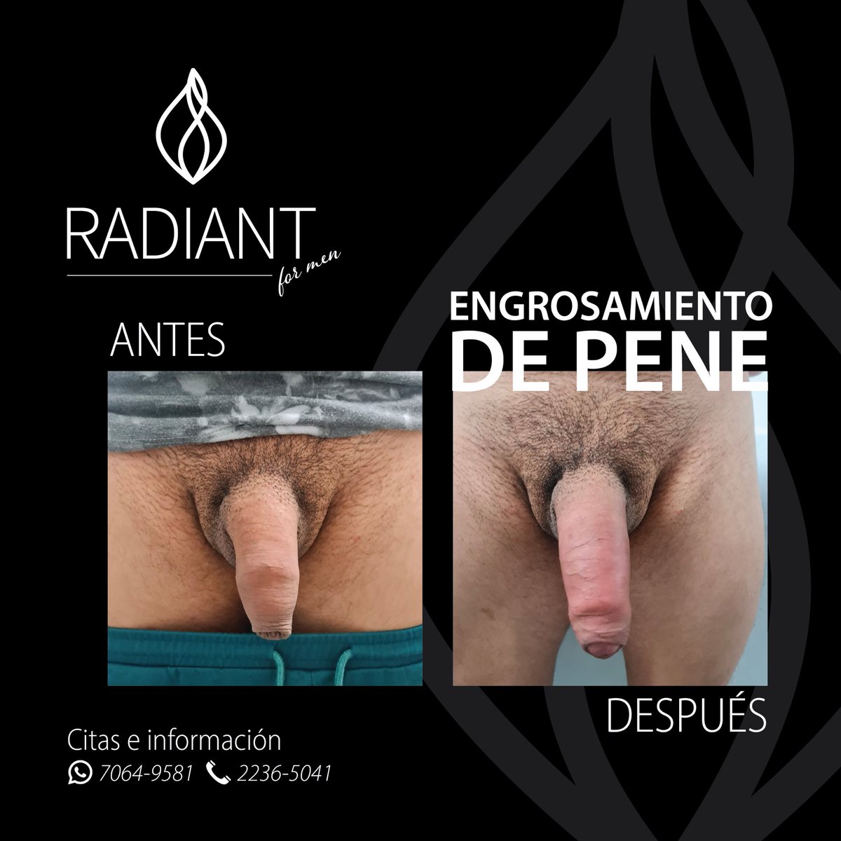 RadiantforMen's tweet photo. #UrologíaEstética 🍌 https://t.co/Bm4CVfxiLC