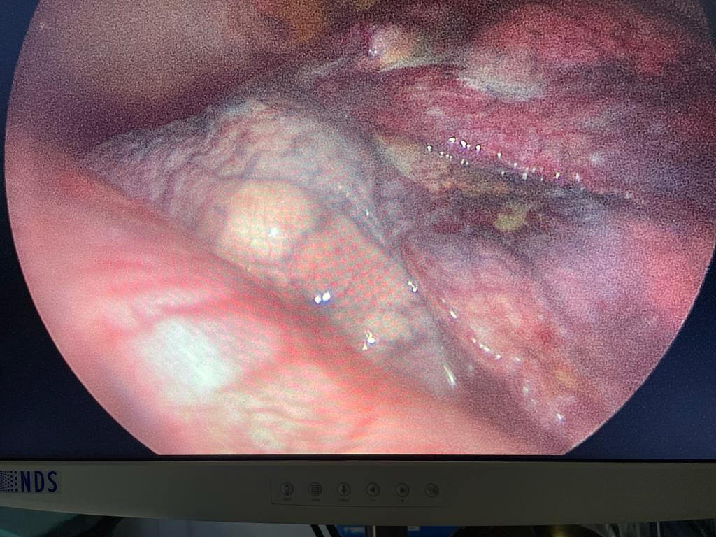 fmunizgonzalez's tweet photo. Otro día en la oficina #pleuroscopia #toracoscopia #lungcancer #neumologiaintervencionista https://t.co/pBWx4SROBC