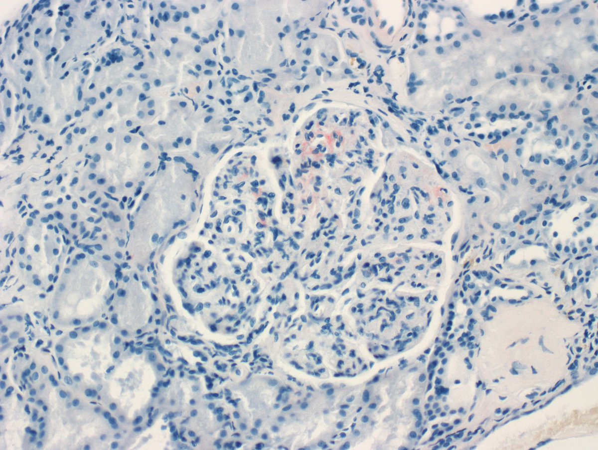 A subtle case of amyloid. Congo red under Texas Red filter is great for picking up amyloid.  #RenalPath