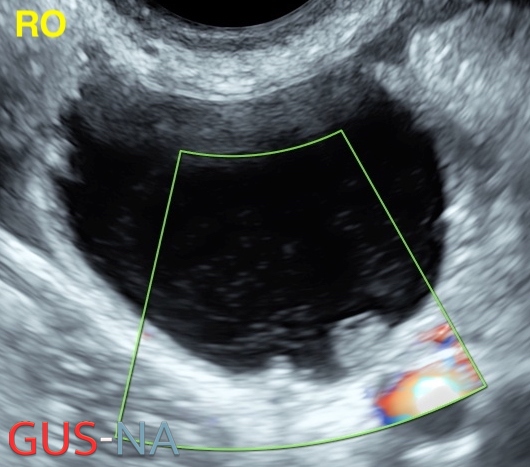 GynUltrasoundNA's tweet photo. What is a SOLID PAPILLARY PROJECTION on ultrasound? Continuing our @iotacongress and #ORADS terms and definitions series from
https://t.co/mA1UQMtTH3 It's the height that is used to define it, width is used in #ADNEX model https://t.co/pwb9A7XdWW