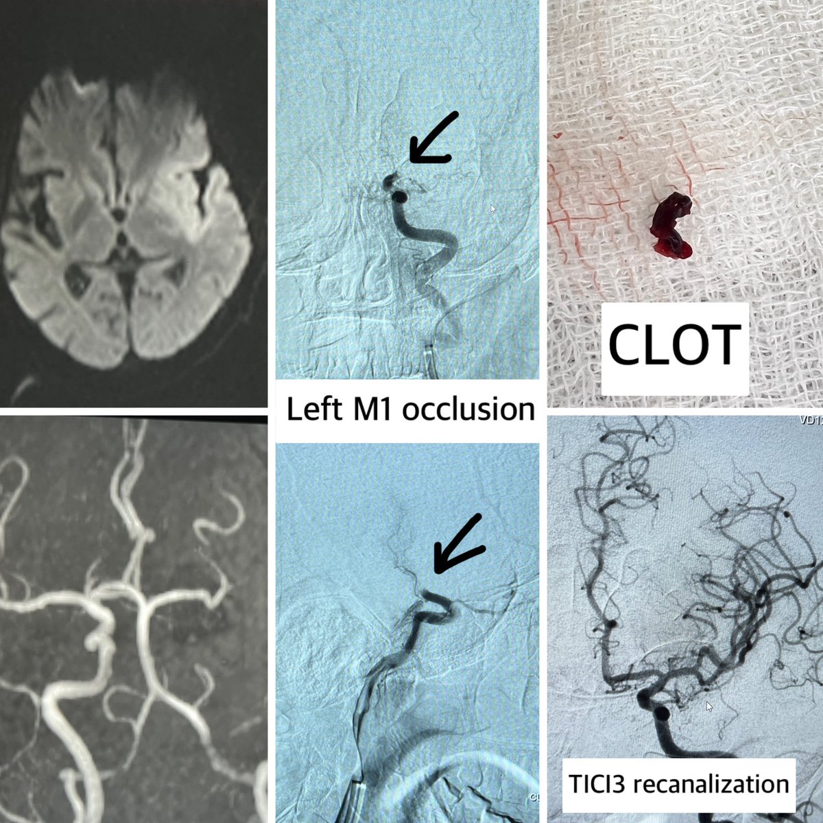 dr_phuyal's tweet photo. Encountered Yet another eg where stroke awareness still lacking in our country.
Operated 2 pts of stroke came to local hospital within golden period of 3h however due to lack of awareness reached our stroke ready center after 10h. Delay in Rx affect the outcome negatively.
#RED72 https://t.co/LVn4zsaTEy