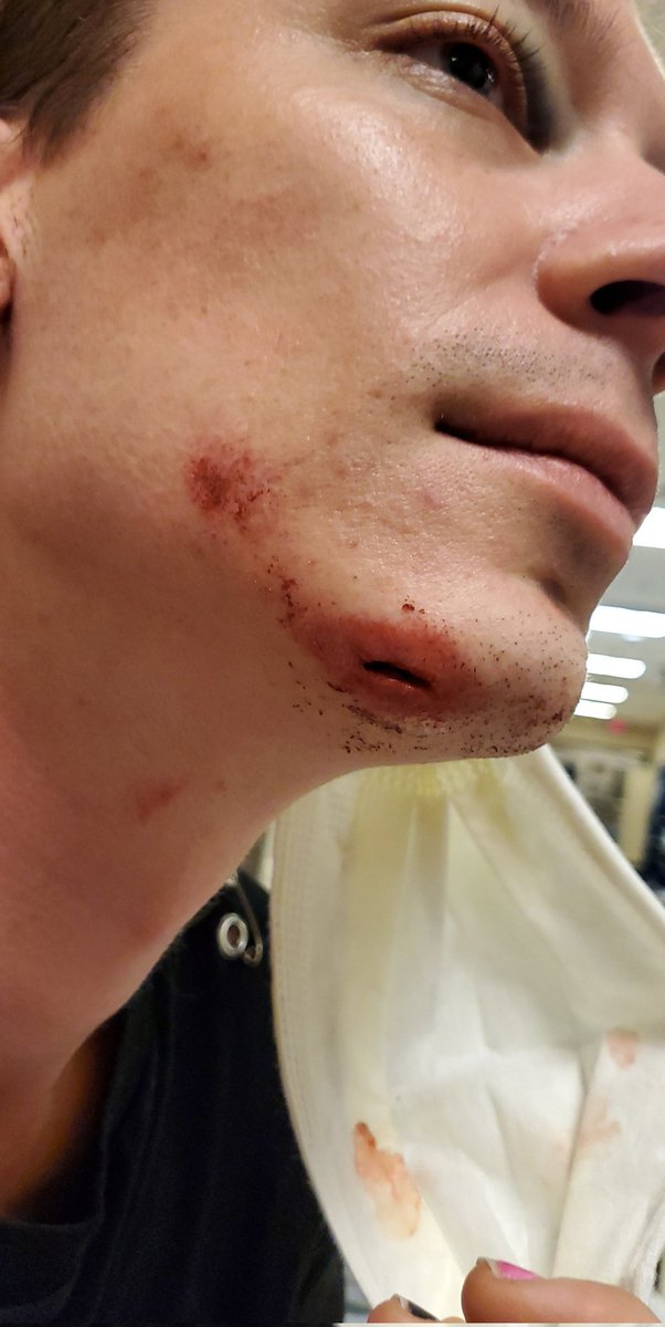 Skward_Hero's tweet photo. The results of my @hollywoodundead concert 😅😂 shouldve stuck the landing better 😂😂😂 https://t.co/1cpHTzo5mw