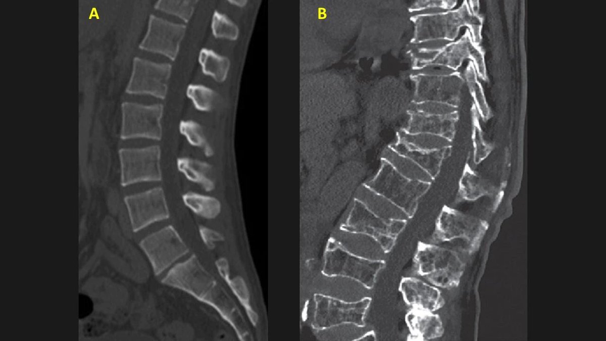 AMP_Honors's tweet photo. Can you answer the question: What is the most common cause of a vertebral insufficiency fracture?
Learn all of this and more on AMP! Create your FREE account at https://t.co/Vgb4kKpNEk
#radiology #radiologicanatomy #osteoporosis #lumbarspine #spine #compressionfracture https://t.co/b2aTIpun7u