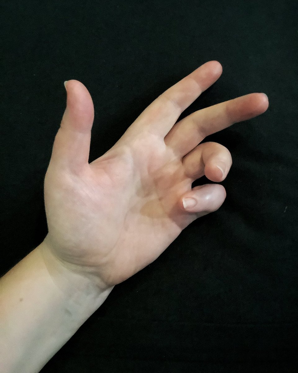 geekamy's tweet photo. 15 days until surgery. I’m nervous but so ready to get this under control.
#dupuytrens https://t.co/3kfxdA9joE