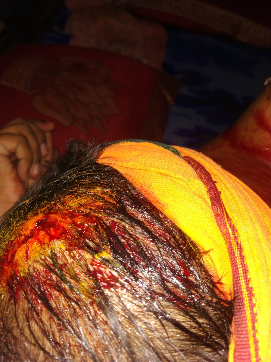 devpathakjanfi4's tweet photo. @doctorrichabjp Nice Interview @doctorrichabjp ji however, I have been victim of assault in Sultanpur Uttar Pradesh..FIR has been ladged in Lambhua PS #0282  and it's been 20 days with no action... I have part of BJYM ..need your help on this... please find my pic of assault...DM for details! https://t.co/KjubbBfr3F