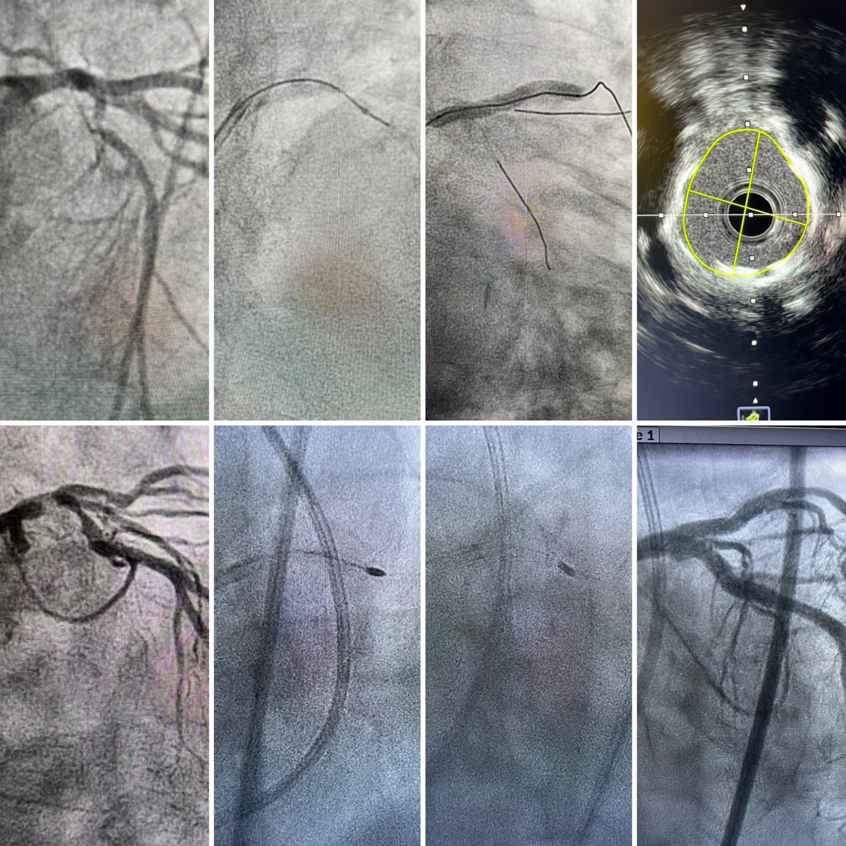 Congrats to our awesome IC and #CHIP fellows (@JTiwanaMD @thinkmdkane) who just did 1) zero-contrast #PCI with #orbital #atherectomy & 2) left main #rotational #atherectomy & #DKcrush, while I was sitting in the control room. Your future is bright! @UWCathLab @uwashfellows