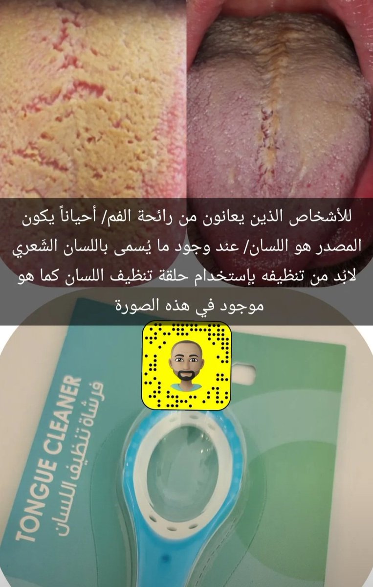 majedalmunif's tweet photo. #صباح_الخير #رائحة_الفم #طب_الاسنان 
البروفيسور خالد الحمدان- استشاري زراعة الاسنان وأمراض اللثة:
فرشاة تنظيف " اللسان 👅" ضرورة لبعض الحالات مثل حالة اللسان الشعري. https://t.co/zrOlmDL2QI