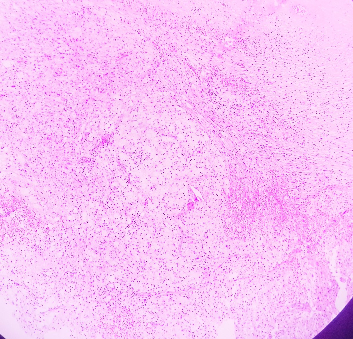 Prachi (@prachipath123) on Twitter photo Xanthogranulomatous cholecystitis-Lipid laden macrophages with chronic active inflammation and fibrosis. #APCON2022 #APCON2022PathTweet <a href="/dr_amenona/">Aswathy Menon Ananthvikas</a> <a href="/archibhat3/">Archana bhat</a> <a href="/Swathiprabhu5/">Swathi Prabhu, MD</a> <a href="/GIJamesMD/">GI James</a> <a href="/Saadia35936148/">Saadia</a> <a href="/padmapathology1/">Padma Priya J</a> <a href="/rositadeolivop1/">Rosalinda Peñaloza</a> <a href="/FlyFan7/">fanbotao</a> <a href="/Kenny92954457/">Kenny De Gracia T.</a> <a href="/AdrianaAncer/">Adriana Ancer</a> Xanthogranulomatous cholecystitis-Lipid laden macrophages with chronic active inflammation and fibrosis. #APCON2022 #APCON2022PathTweet <a href="/dr_amenona/">Aswathy Menon Ananthvikas</a> <a href="/archibhat3/">Archana bhat</a> <a href="/Swathiprabhu5/">Swathi Prabhu, MD</a> <a href="/GIJamesMD/">GI James</a> <a href="/Saadia35936148/">Saadia</a> <a href="/padmapathology1/">Padma Priya J</a> <a href="/rositadeolivop1/">Rosalinda Peñaloza</a> <a href="/FlyFan7/">fanbotao</a> <a href="/Kenny92954457/">Kenny De Gracia T.</a> <a href="/AdrianaAncer/">Adriana Ancer</a>