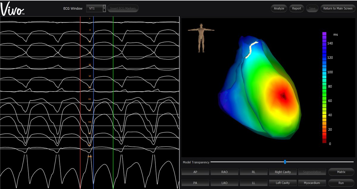 Another fabulous day of VT mapping <a href="/DhanjalTarv/">Tarv Dhanjal, PhD, FESC</a> and VIVO.  Two VT exit sites mapped and successfully ablated.  #VIVO <a href="/CatheterInc/">Catheter Precision Inc</a>