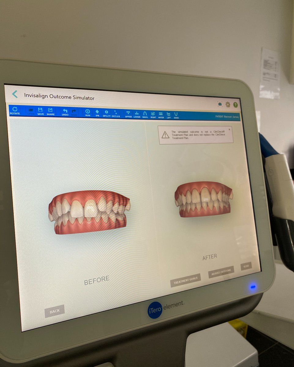 We love the iTero intraoral scanner as it allows our patients to see what their teeth will look like after having Invisalign with us!

Look at the results here👇