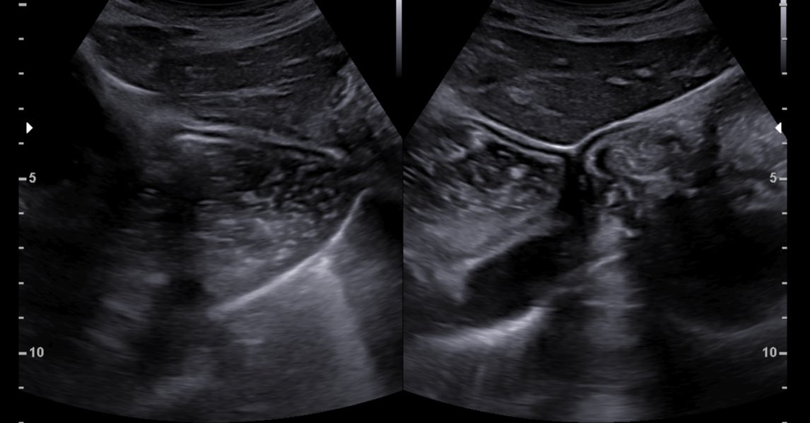 ShiviRadiology's tweet photo. Patient came for #Ultrasound Abdomen with complains of difficulty in eating.
Diagnosis- #Achalasia 
Diagnosed by- Dr Garima Goel
Complete case- https://t.co/UXouKLjTHo https://t.co/inKr27Pi19