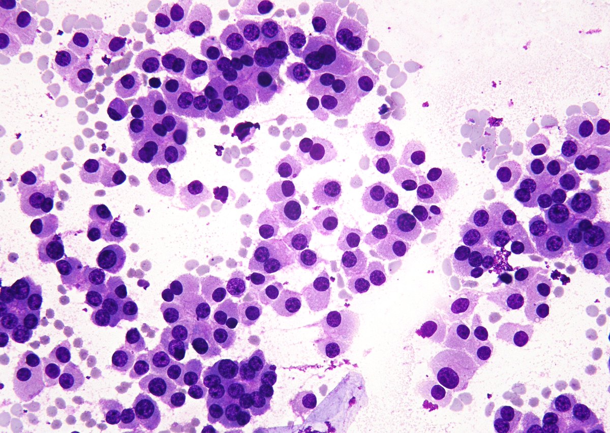 ... and yet more creative "dotting" by the Cytotech. Thyroid FNA of an "Oncocytic Follicular Neoplasm" (the forthcoming "2023 TBSRTC" name). One can appreciate the "pseudo-medullary carcinoma" appearance.
