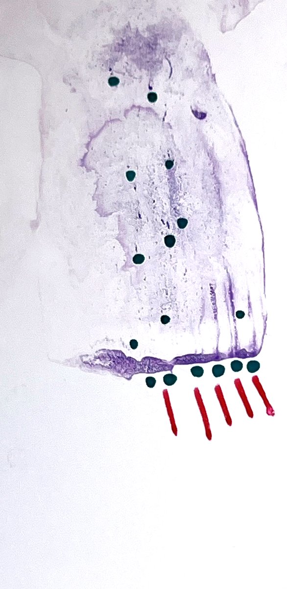 sza_jhcyto's tweet photo. ... and yet more creative "dotting" by the Cytotech. Thyroid FNA of an "Oncocytic Follicular Neoplasm" (the forthcoming "2023 TBSRTC" name). One can appreciate the "pseudo-medullary carcinoma" appearance. https://t.co/by0AjMTXmT
