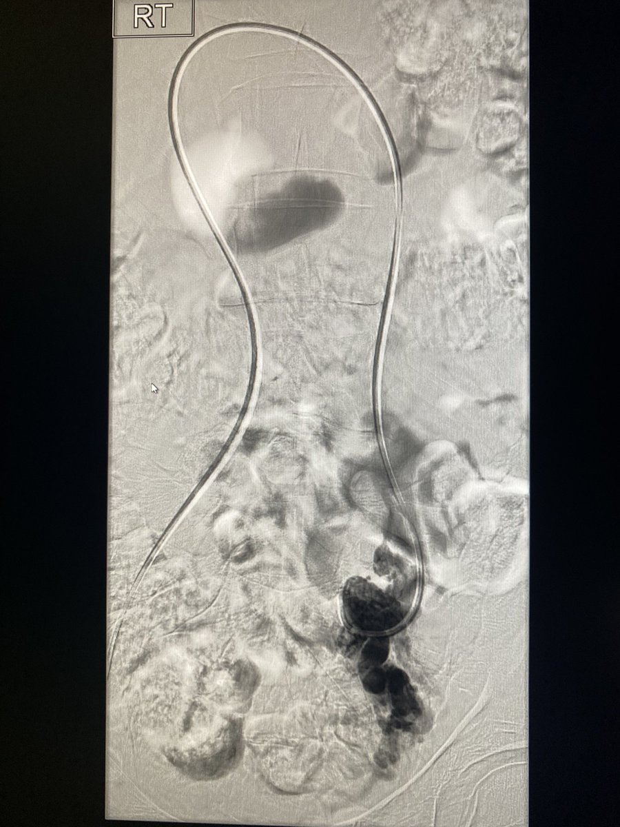 DougMulholland's tweet photo. Chronic pain secondary to pelvic congestion in young female with good symptomatic relief at 3 mos post simple ovarian vein embolisation. I wouldn’t argue with Dwight Schrute but maybe less is more with these patients🤔 #TwittIR @BeaumontRadiol1 @johnnyomahony @logesselva @Shyner0 https://t.co/WSfU1kcyYi