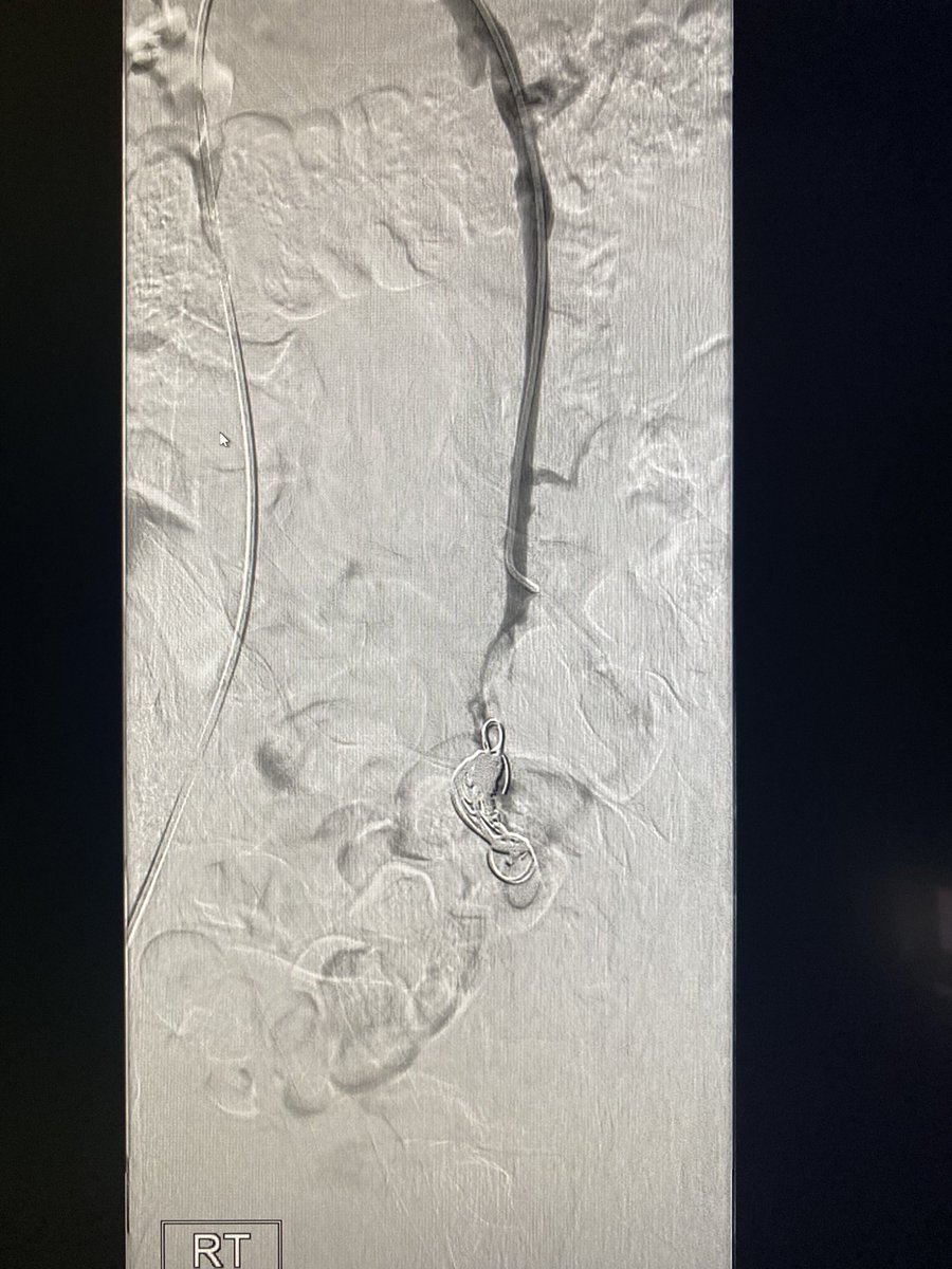 DougMulholland's tweet photo. Chronic pain secondary to pelvic congestion in young female with good symptomatic relief at 3 mos post simple ovarian vein embolisation. I wouldn’t argue with Dwight Schrute but maybe less is more with these patients🤔 #TwittIR @BeaumontRadiol1 @johnnyomahony @logesselva @Shyner0 https://t.co/WSfU1kcyYi