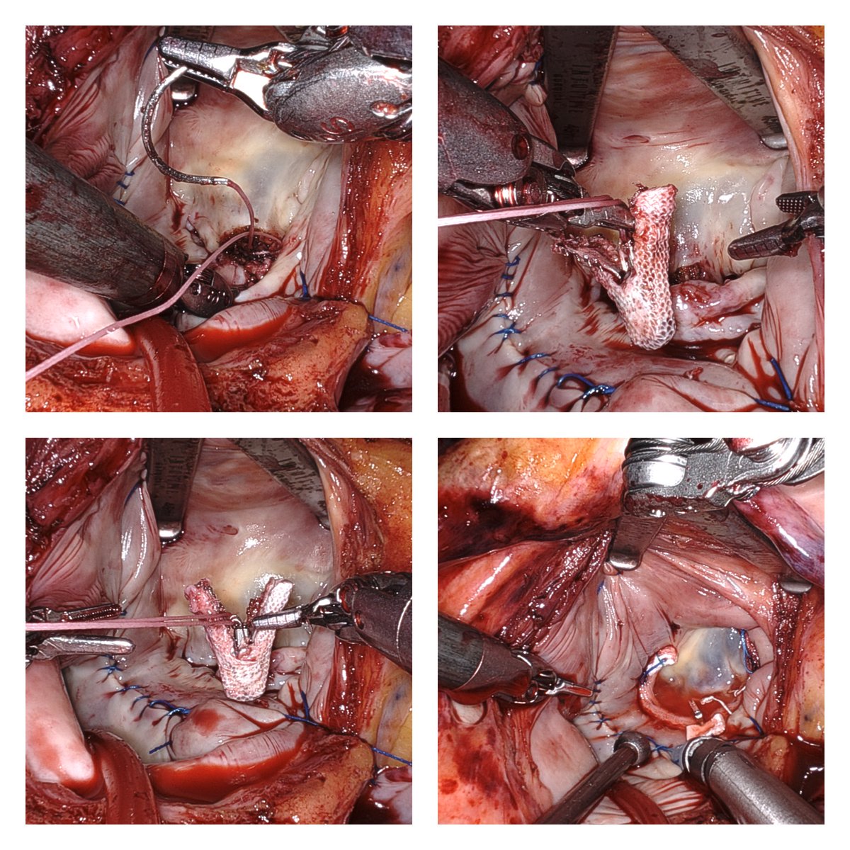 Amazing case @TJUHospital - robotic endoscopic removal of prior Mitraclip X 2 followed by Mitral valve repair with neochords and band, cryo MAZE, tricuspid valve repair, PFO and LAA closures. 8 mm working port and all percutaneous cannulation, extubation in the OR. @JEFFsurgery