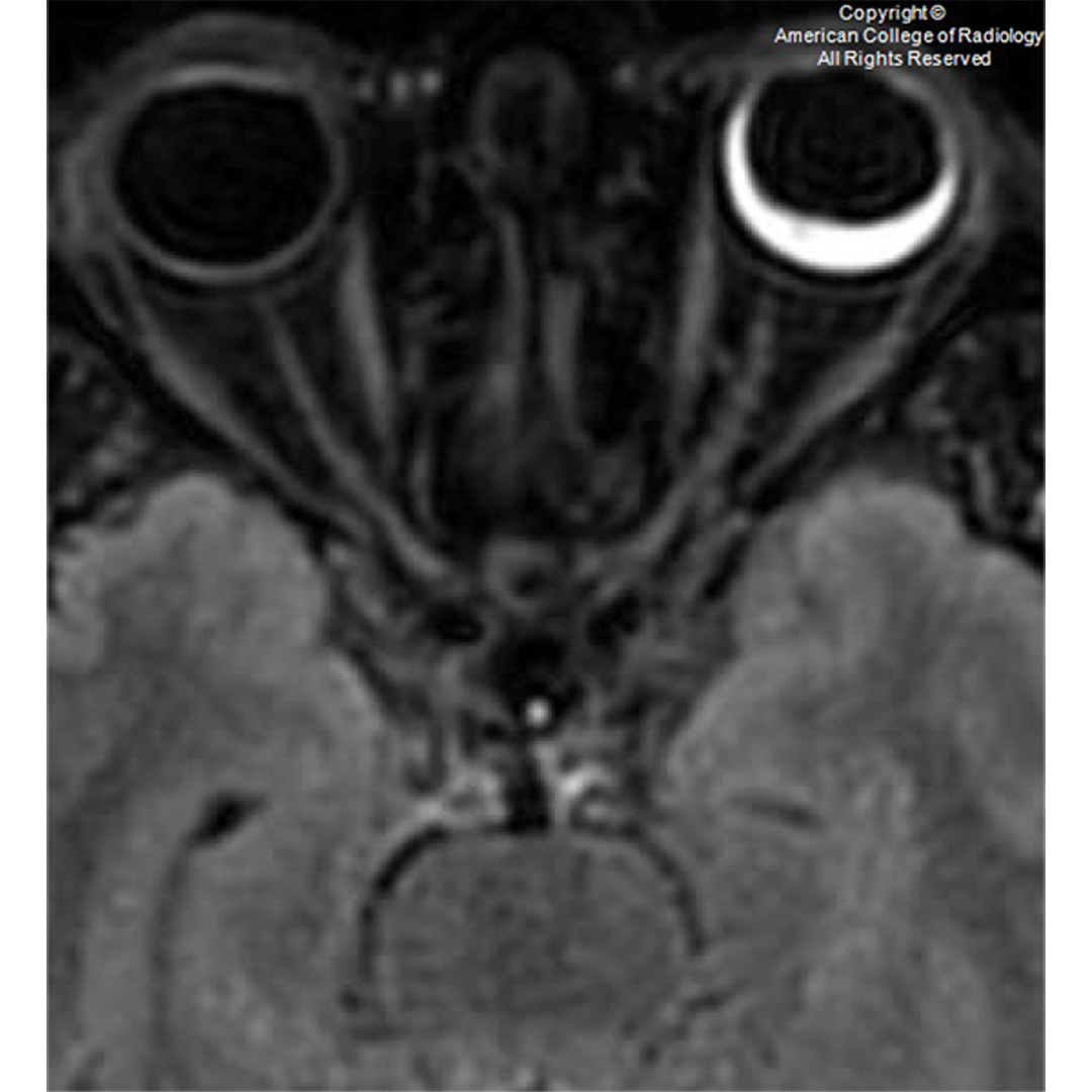 American College of Radiology on Twitter "A 57yearold woman presents