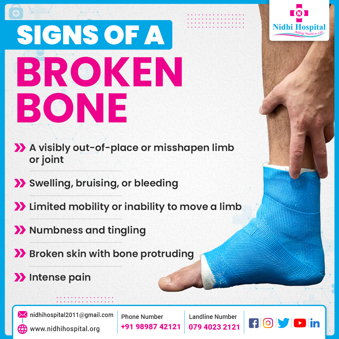 #BrokenBones can happen after an #accident or by being hit by an object. It can also occur if more pressure is given to a #bone.
It calls for immediate #emergency as an untreated #fracture can cause innumerable other issues.
Consult Best #Orthopedist at #NidhiHospitals.