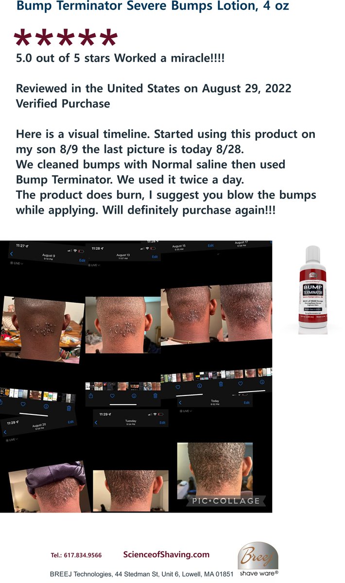 BUMPDOC's tweet photo. Back of Head Bumps? Ready for Fast Resolution of your Problem? Check out the Latest 5 Star Review on Amazon. Get the BUMP TERMINATOR Lotion Now. Results in 24hrs #ShavingBump #IngrownHair #RazorShaving #BumpTerminators #BikiniBump #Shaving https://t.co/JorjRJNhXh #Amazon https://t.co/eq6BPNwQk9