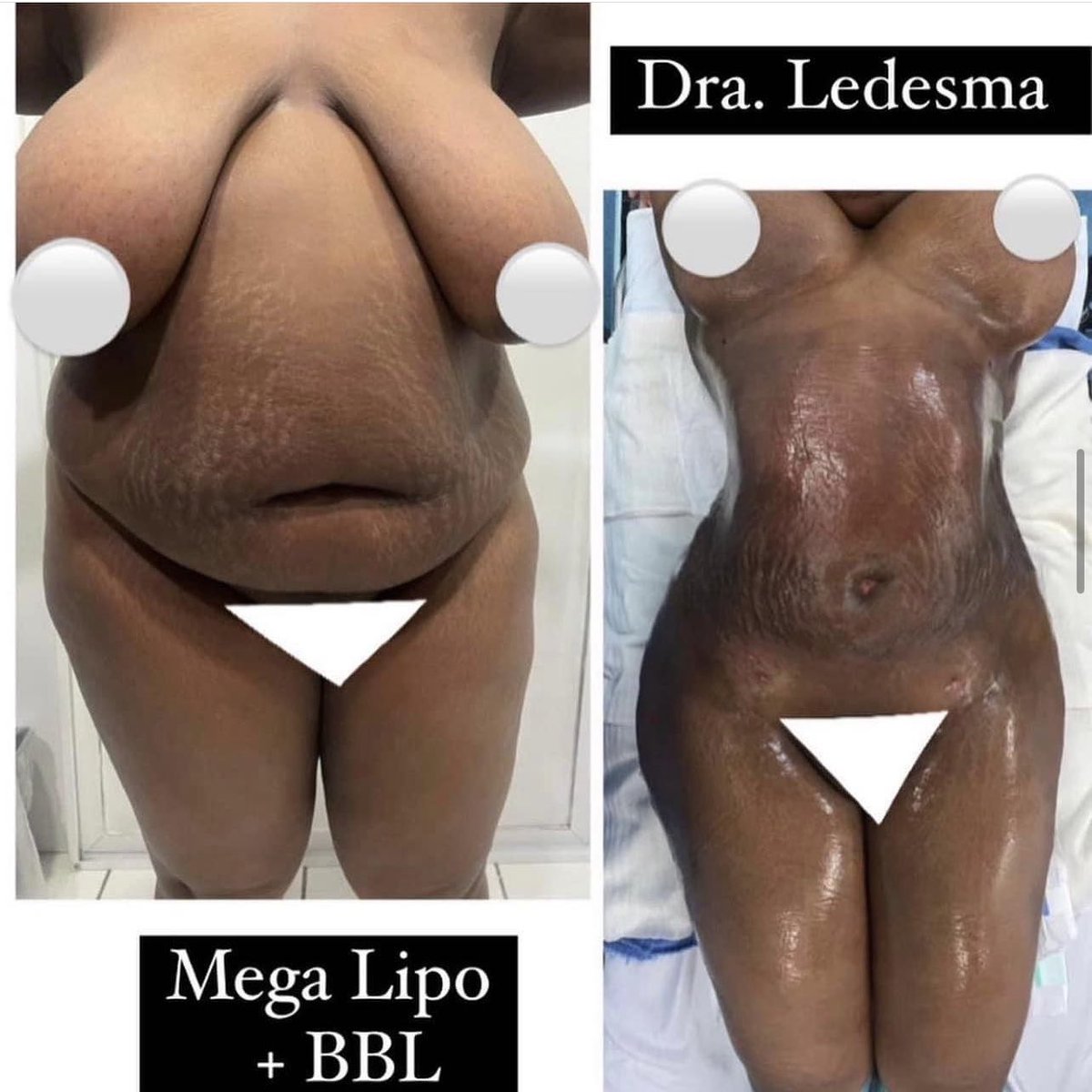 BodybyDoctor's tweet photo. Message us for more information!
#Lipo360 #plasticsurgery #MMO #results #BodyByDoctor #TheBestDoctors https://t.co/pMmTBxvbNF