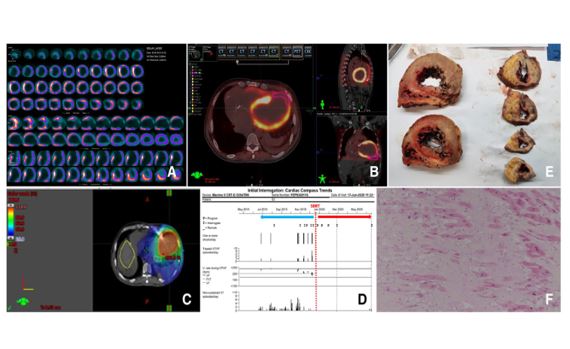 🚨Latest #FreeRead in @JICE_EP Stereotactic body radioablation therapy as an immediate and early term antiarrhythmic palliative therapeutic choice in patients with refractory VT by @DursunAras2 @MDTolgaAksu & S Topaloglu 📖 #FreeRead: rdcu.be/cUHQq #EPeeps