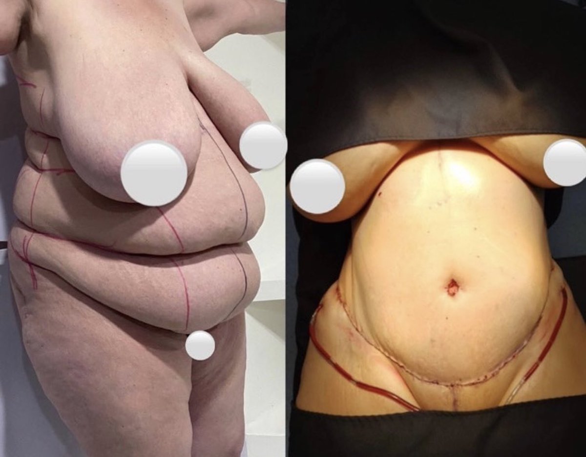 BodybyDoctor's tweet photo. Amazing Tummy for Dr. B! Don’t miss this amazing August promo! Message is for more information #BodyByDoctor #TummyTuck #MMO #Lipo360 #beforeandafter #Results #DrB #plasticsurgery https://t.co/ykI35UFAps