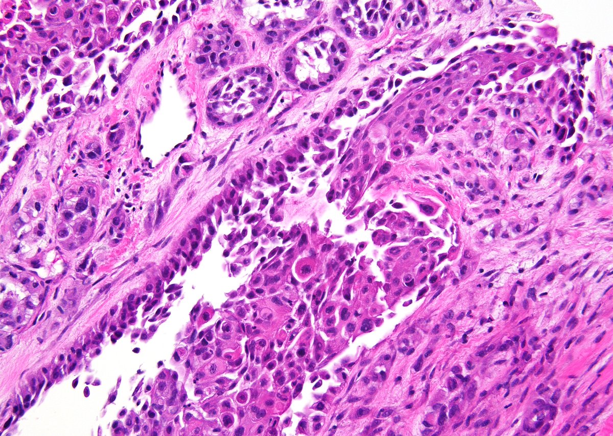 "Straight from the scope" - A great educational case. Elderly female with a lateral back soft tissue mass and a previous history of an upper urinary tract high-grade urothelial carcinoma with extensive squamous differentiation. FNA consistent with metastasis. (Smears, CB and CBX)