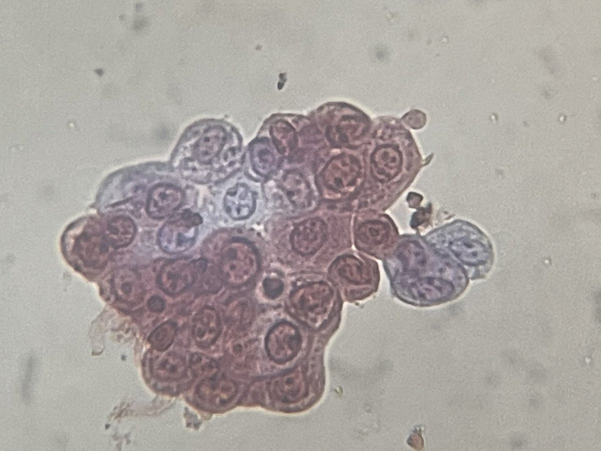 Nephro_Ivan's tweet photo. Cúmulo de células tubulares y transicionales 🔬
#urinarymicroscopy
#urinesediment
#urinarysediment https://t.co/qOKOGkLvaM