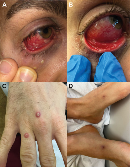 AAOjournal's tweet photo. Unilateral blepharoconjunctivitis due to #monkeypox virus infection. Exam revealed multiple (> 10) umbilicated papules on the tarsal and bulbar conjunctiva and lesions elsewhere on the body. Ocular papules resolved after treatment with IV cidofovir. https://t.co/3h4bpFhPsr https://t.co/8Z8eNaY8G8