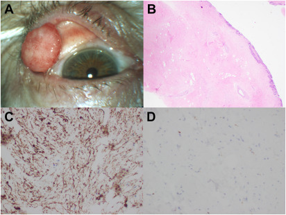 AAOjournal's tweet photo. A patient presented with a firm pedunculated tarsal lesion with a flattened top molded to the contour of the globe. The lesion was excised and found to be a tarsal fibroma of the eyelid - a rare benign lesion. @uicovs @aaronkaufmanmd @AnnQTran https://t.co/EJj4BwsSz1 https://t.co/7uIGOgaZnG